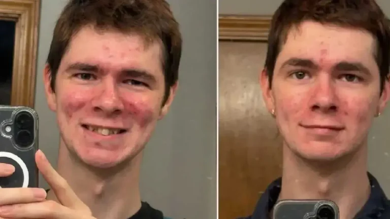 He Hid His Smile Because of His Teeth. Strangers Raised $19,000 to Help